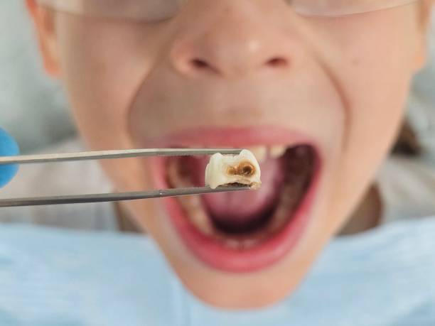 Best Emergency Dental Care for Broken or Chipped Teeth in Rosenberg, TX